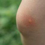 Anak Digigit Nyamuk dan Muncul Bentol Merah