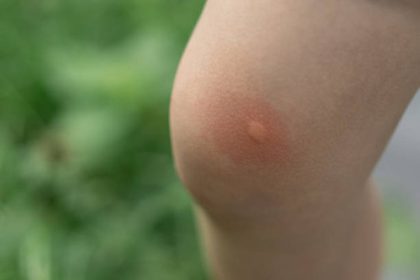 Anak Digigit Nyamuk dan Muncul Bentol Merah